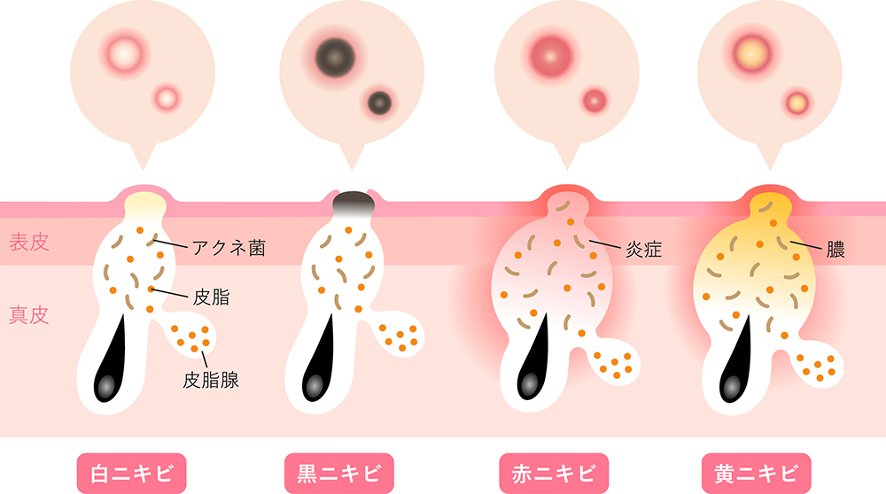 ニキビの種類