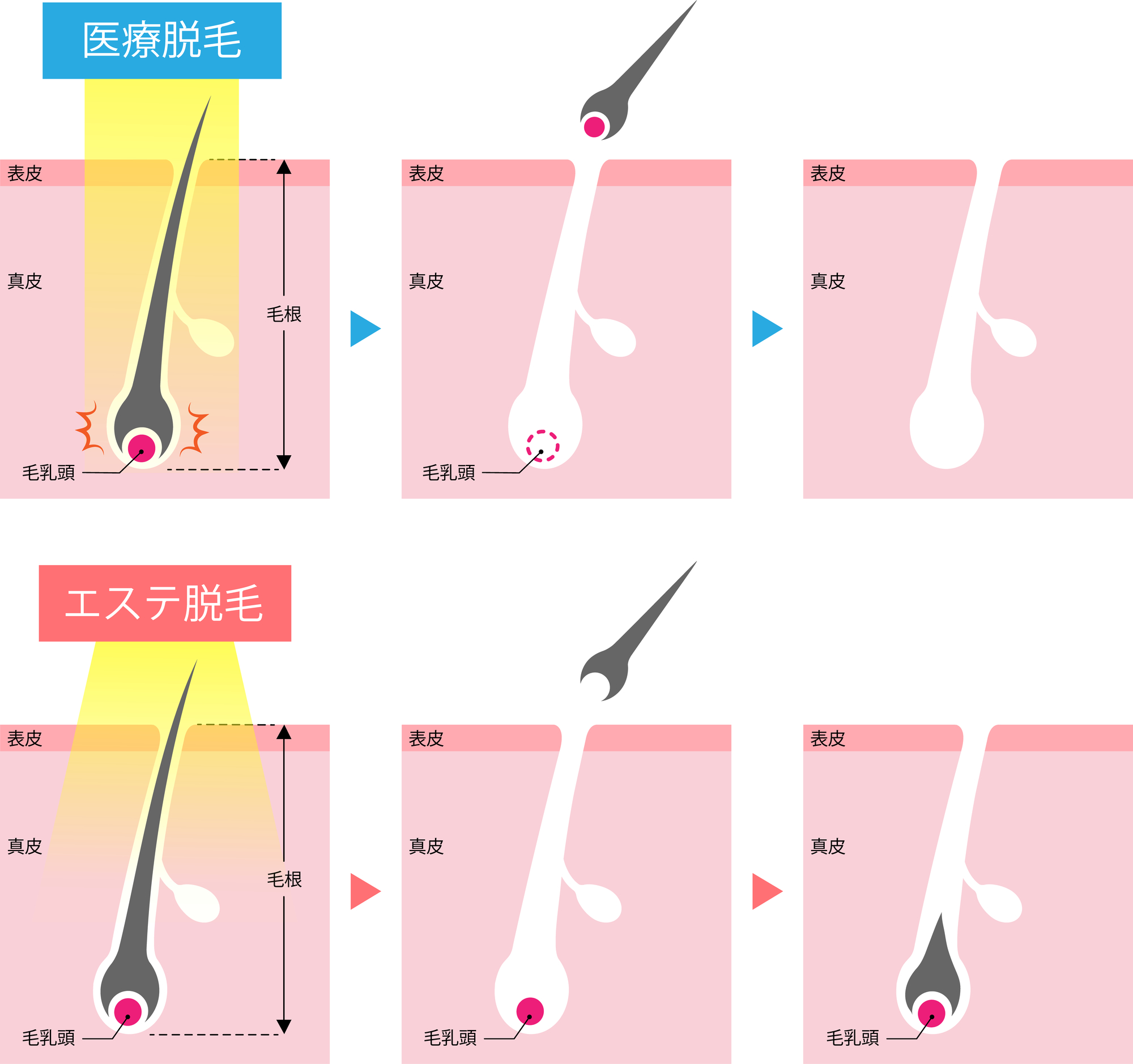 レーザー脱毛とエステ脱毛の違い