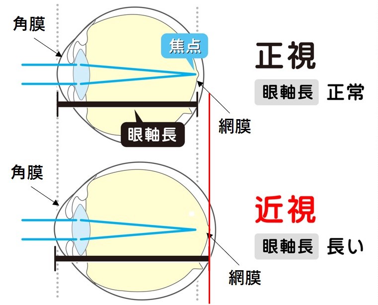 近視について