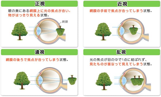 屈折異常・斜視