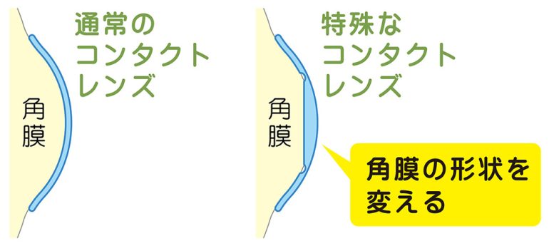 オルソケラトロジーについて