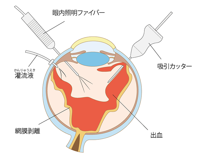 硝子体(しょうしたい)手術について